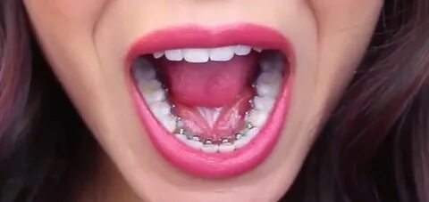 Brackets meaning