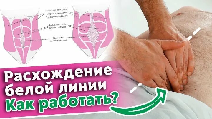 Диастаз прямых мышц живота. Разрывы лонного сочленения диагностика принципы лечения. Расхождение лобного сочленения. Тейп диастаз. Расхождение белой.