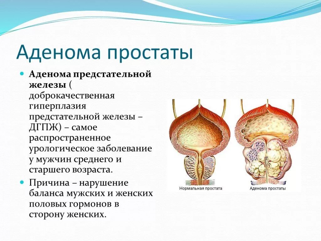 Методы лечения предстательной железы. Доброкачественная гиперплазия (аденома) предстательной железы. Схема лечения аденомы предстательной железы у мужчин. Аденома простаты ДГПЖ 2 степени. Аденома предстат железы признак.