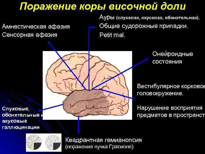 Нарушение коры полушарий. Синдромы поражения затылочных долей головного мозга. Синдром поражения височной доли головного мозга. Синдромы поражения коры головного мозга. Синдром поражения височной доли неврология.