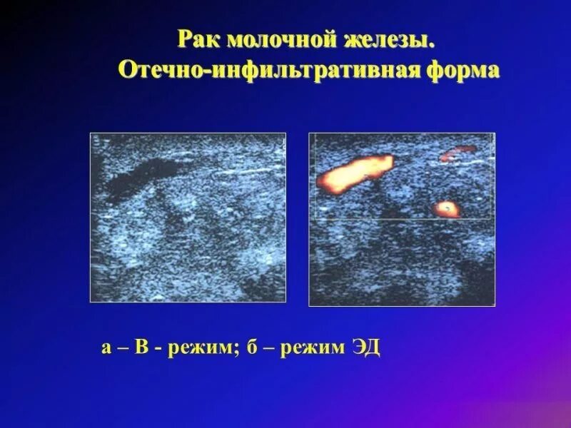 Отечная форма рака молочной. Отечно-инфильтративная форма рмж. инфильтративно-отечной формы рака,. инфильтративно отечная форма молочной железы. инфильтрирующая карцинома молочной железы узи.