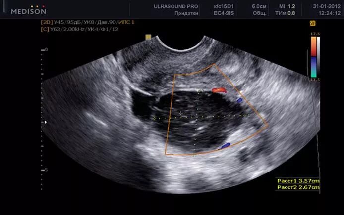 фолликулярный яичник на узи. регресс кисты яичника на узи. преовуляторный фолликул на узи. доминантный фолликул на узи. киста желтого тела яичника на узи.