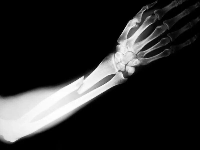 Break a bone. Перелом диафиза лучевой кости рентген. Перелом костей лучезапястного сустава. Перелом костяшки рентген. Открытый перелом предплечья рентген.