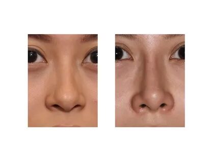 Nose am