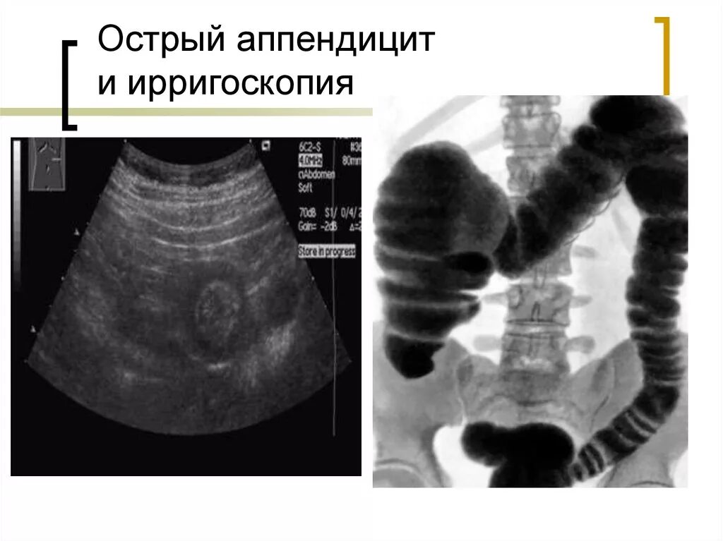 Какое узи при аппендиците