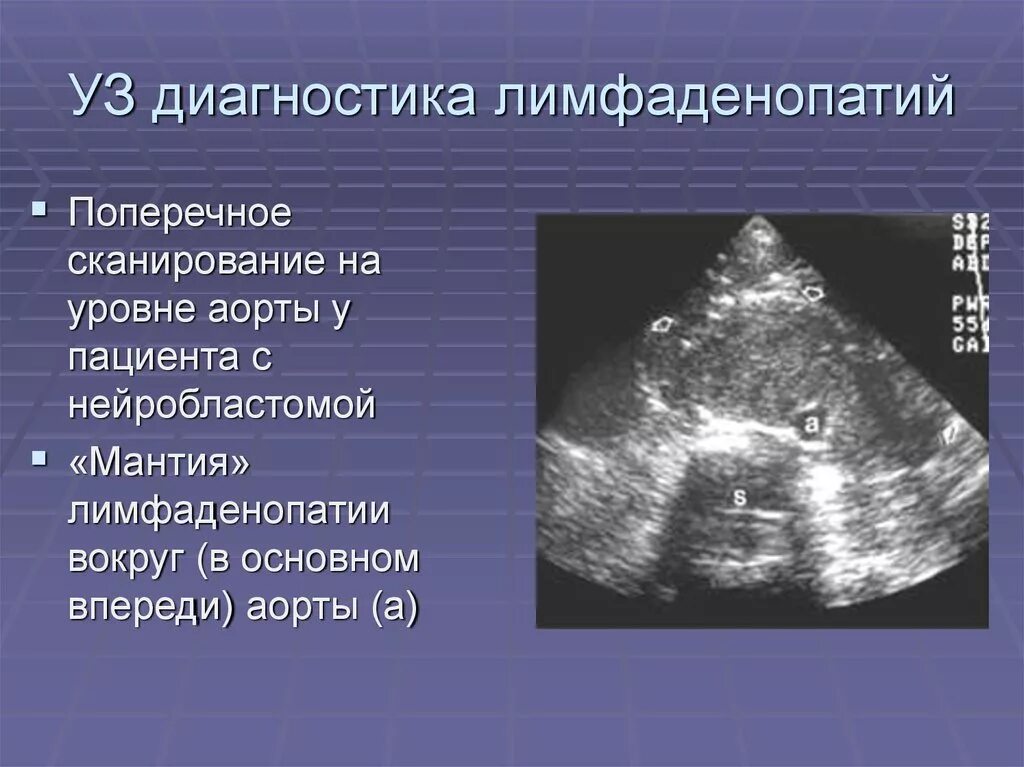 УЗИ лимфоузлов брюшной полости. Забрюшинные лимфоузлы на УЗИ. Лимфоузлы брюшной полости на УЗИ. Лимфаденопатия печени