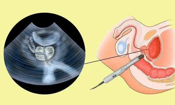Диффузные предстательной железы. Киста парауретральные железы. изменение в предстательной железе. диффузные изменения в предстательной железе.