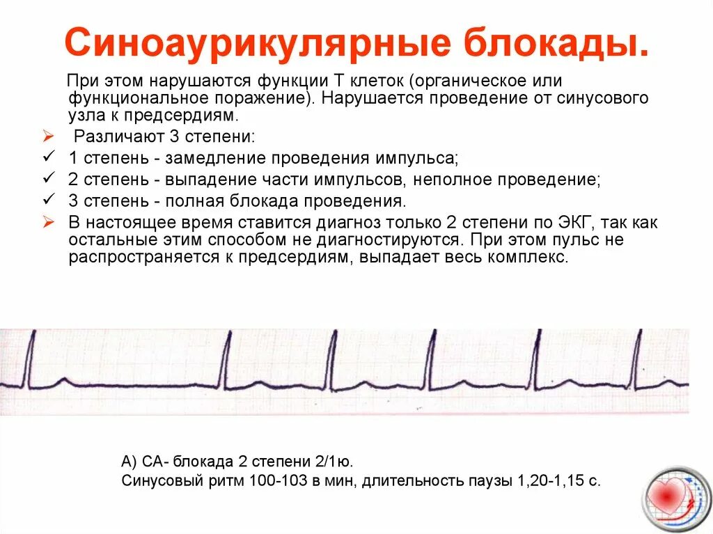 Блокада узла. Блокада синусового узла 2 степени. ЭКГ-признаки са-блокады II степени Мобитц 1. Синоатриальная блокада 2 степени на ЭКГ. Синоатриальная блокада 1 степени на ЭКГ.