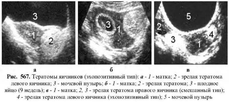 Кистозная тератома яичника УЗИ. Дермоидная киста опухолей яичников. Тератома яичника УЗИ картина. Рак после удаления яичников