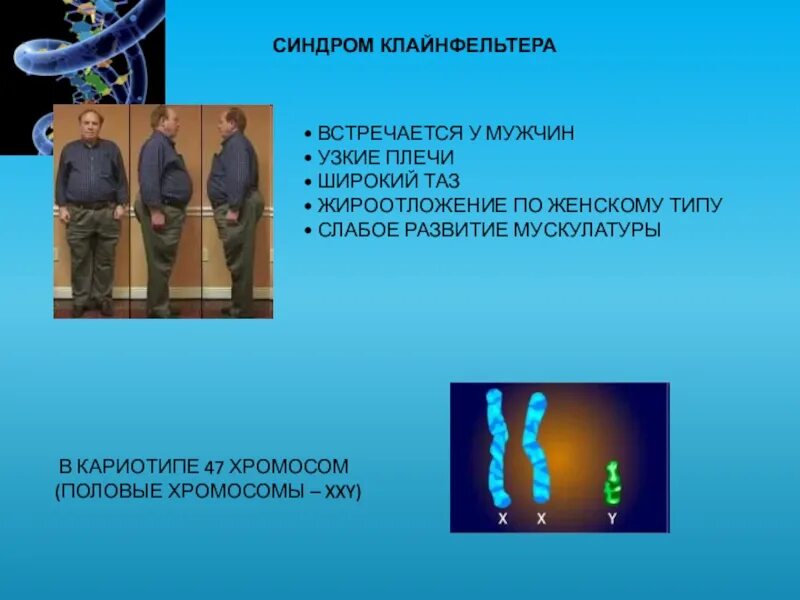 Xxy хромосома. Клинические признаки синдрома Клайнфельтера. Половые хромосомы. Синдром Клайнфельтера фото.