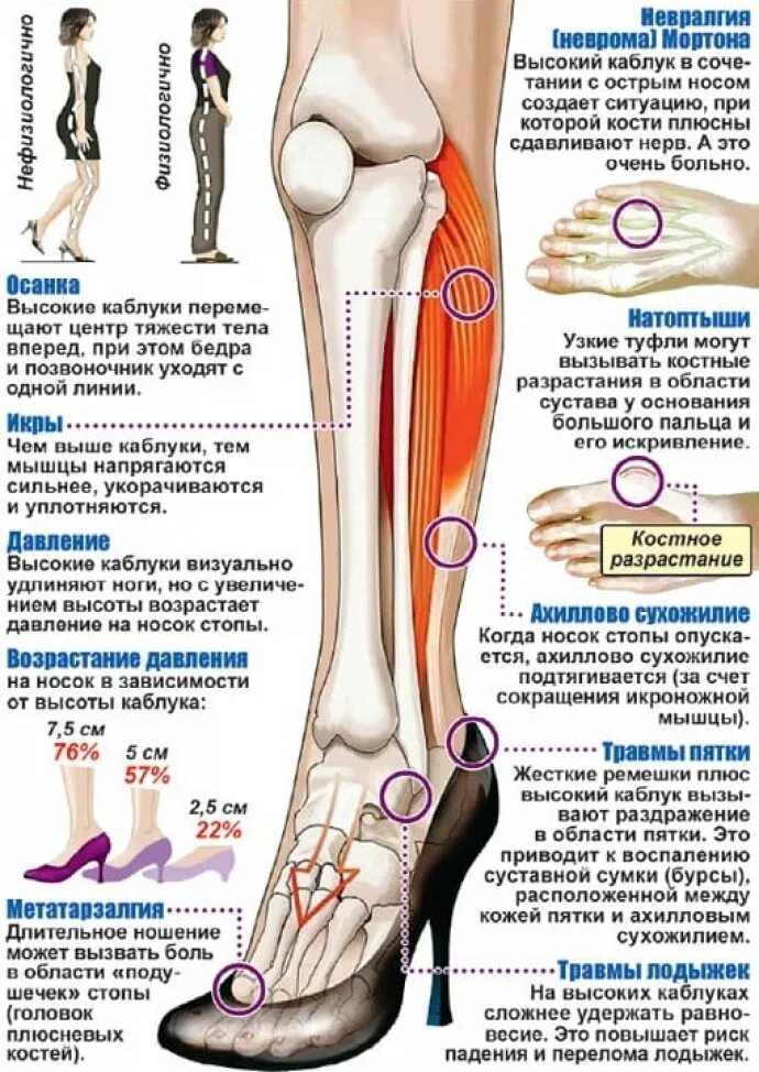 Ноет нога выше колена. Кость на ноге от высоких каблуков. Косточки на стопе от высоких каблуков.