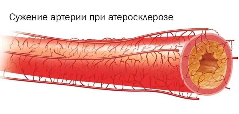 Атеросклероз артерий без. Атеросклеротическое поражение кровеносных сосудов. атеросклероз сосудов бцс. атеросклероз генерализованный 170.9. атеросклероз сосудов бца.