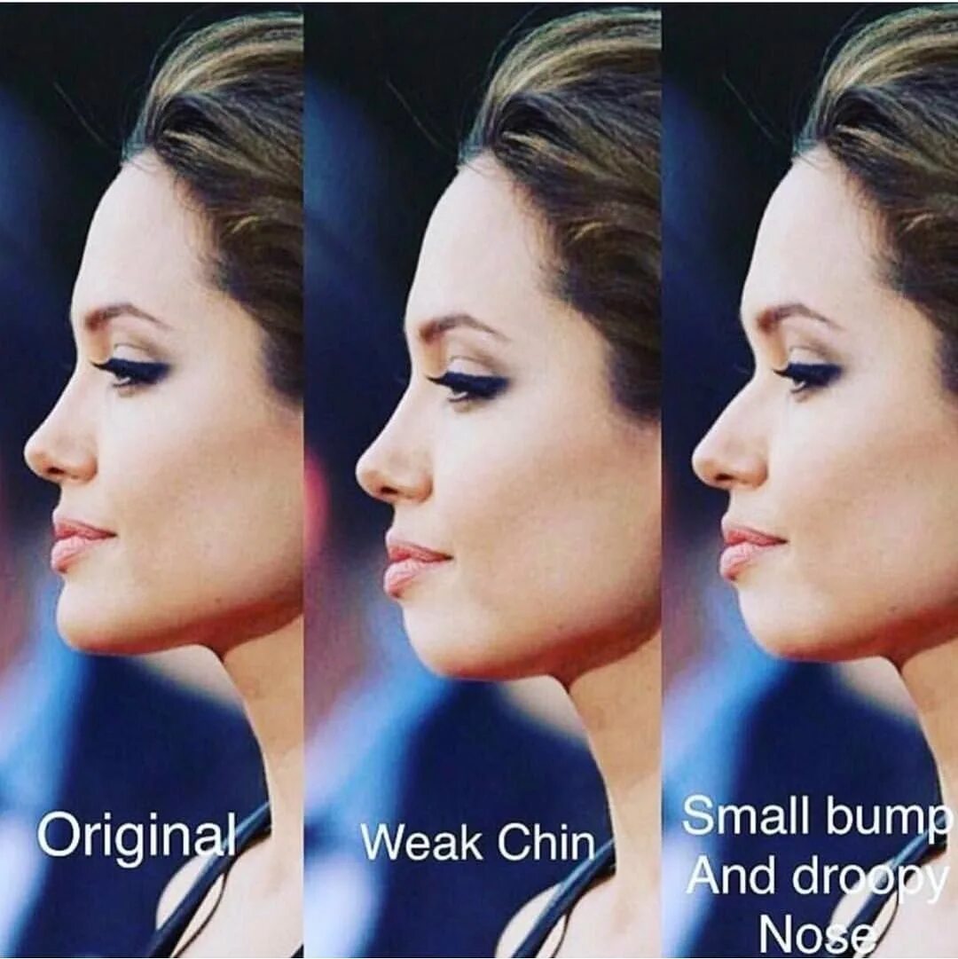 Бывшие профиль. Типы профилей лица. Плоский подбородок. Нос с горбинкой у девушки. Дистальный (прогнатический) прикус.