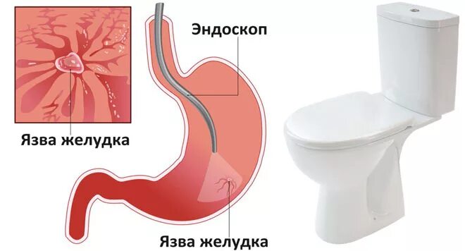 Стул при язвенной болезни. Понос при язвенной болезни. Цвет кала при язвенной болезни.