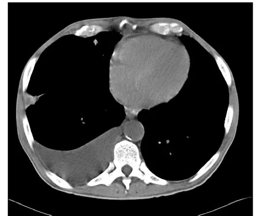 Осумкованная эмпиема на кт. Фибринозный плеврит кт. Плеврит на кт. Лучевая диагностика плевритов. Плеврит на кт.