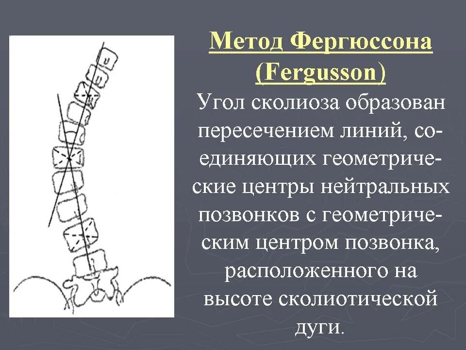 Метод Кобба сколиоз степени. Степени сколиоза позвоночника по коббу. Сколиоз по коббу степени рентген. Метод Фергюсона сколиоз. Угол кобба