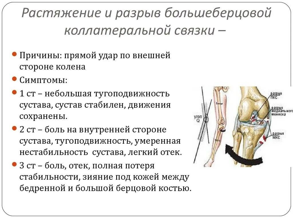 Диагностика повреждений боковых связок. Признаки повреждения медиальной боковой связки коленного сустава. При повреждении связки коленного сустава. Повреждение связочного аппарата левого коленного сустава. Симптомы крестообразной связки коленного сустава