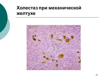 Печень при застойной желтухе микропрепарат