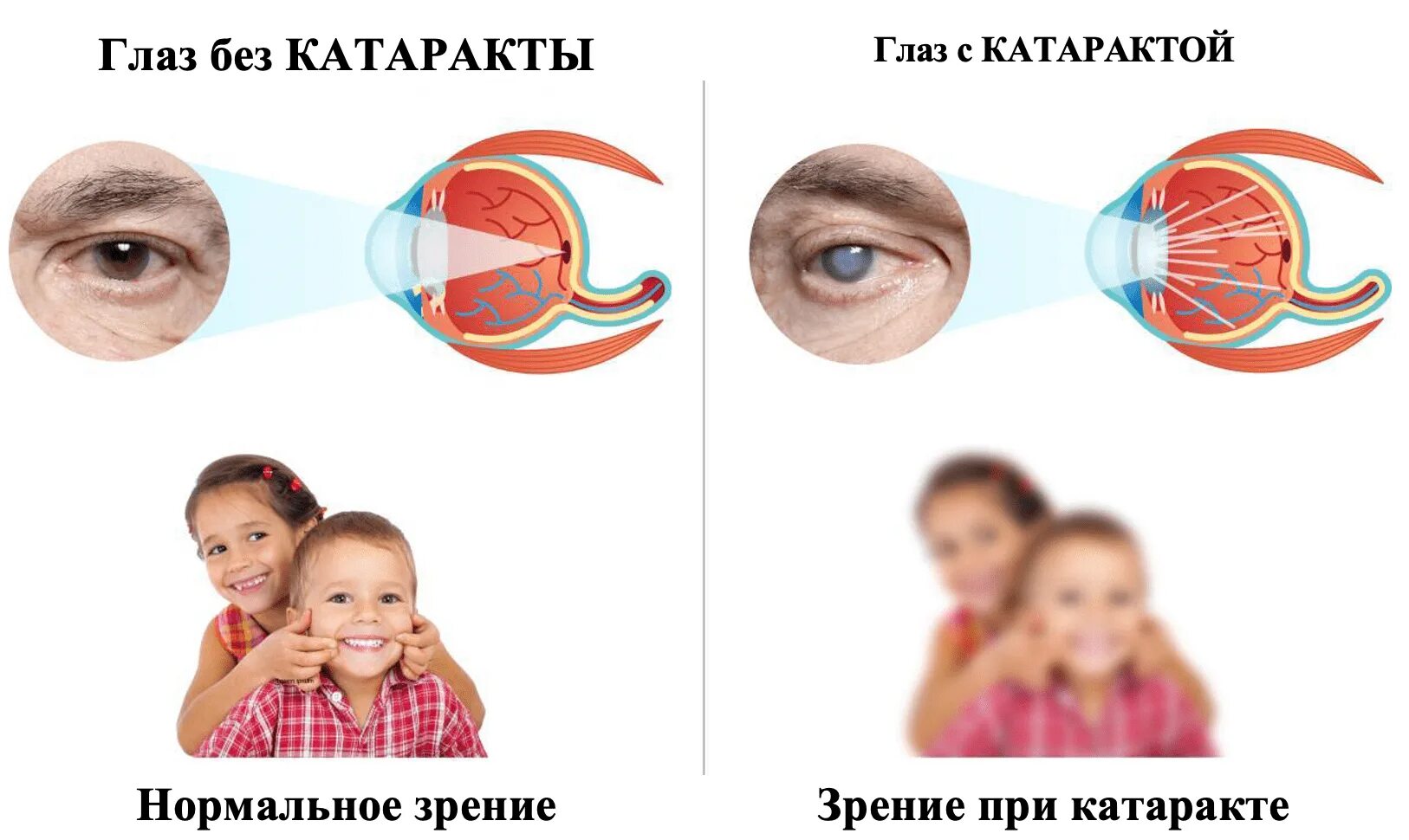 Как видят при катаракте