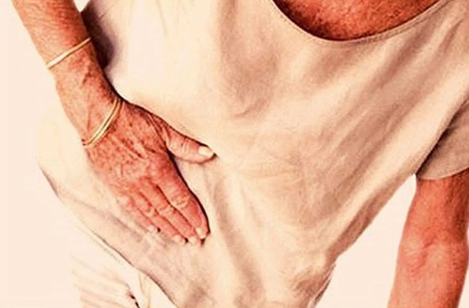 Желтушное окрашивание кожных покровов. Бессимптомный цирроз печени. Желтушность кожных покровов. Холестатический синдром. Гастрит у пожилых людей.