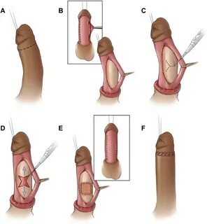 Penis desinfizieren.