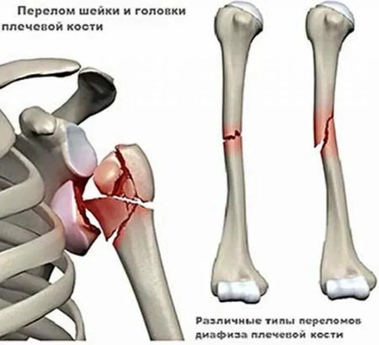 При подозрении перелом плеча у человека важно. Перелом диафиза плечевой кости. оскольчатый перелом плечевой кости. перелом плечевой кости мкб. переломы диафиза плечевой кости симптомы.