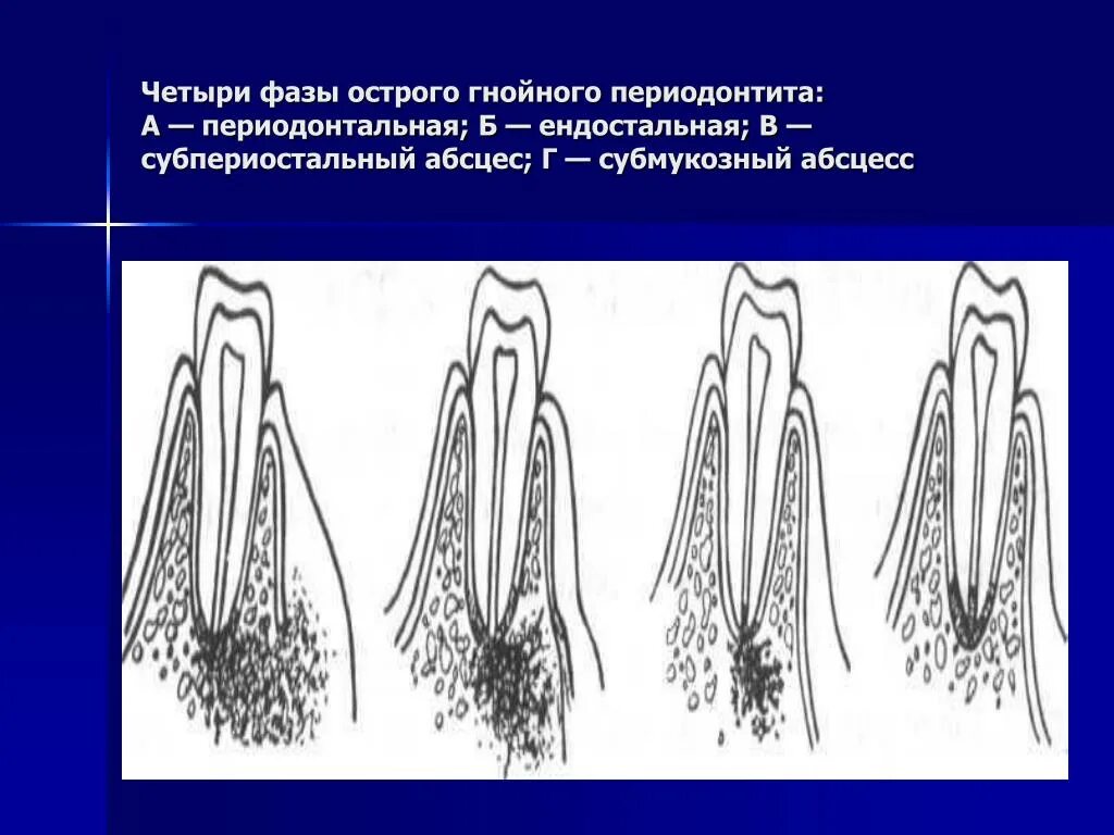 Гранулирующий периодонтит рентгенограмма. Апикальный (верхушечный) периодонтит. Острый апикальный периодонтит рентгенограмма. Острый Гнойный апикальный периодонтит. Осложнение лечения периодонтита