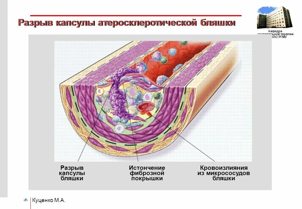 Разрыв атеросклеротической бляшки. Структура атеросклеротической бляшки. Разрыв капсулы атеросклеротической бляшки. Фиброзная покрышка атеросклеротической бляшки.