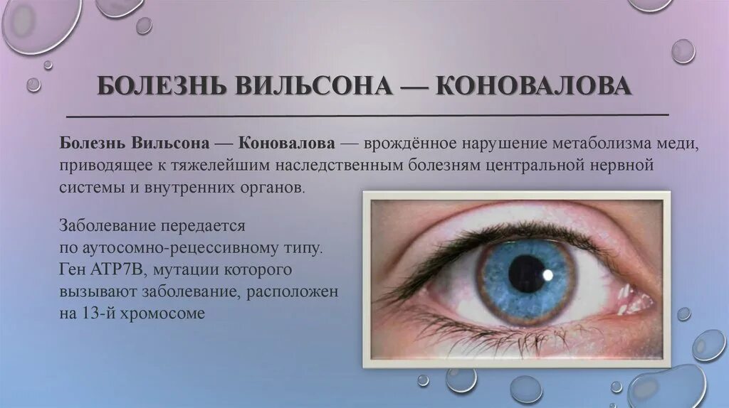 Синдром вильсона коновалова что это такое простыми. Болезнь Вильсона Коновалова кольца Кайзера-Флейшера. Кольцо Флейшера болезнь Коновалова- Вильсона. Кольцо Флейшера при болезни Вильсона-Коновалова. Болезнь Вильсона Коновалова радужка.