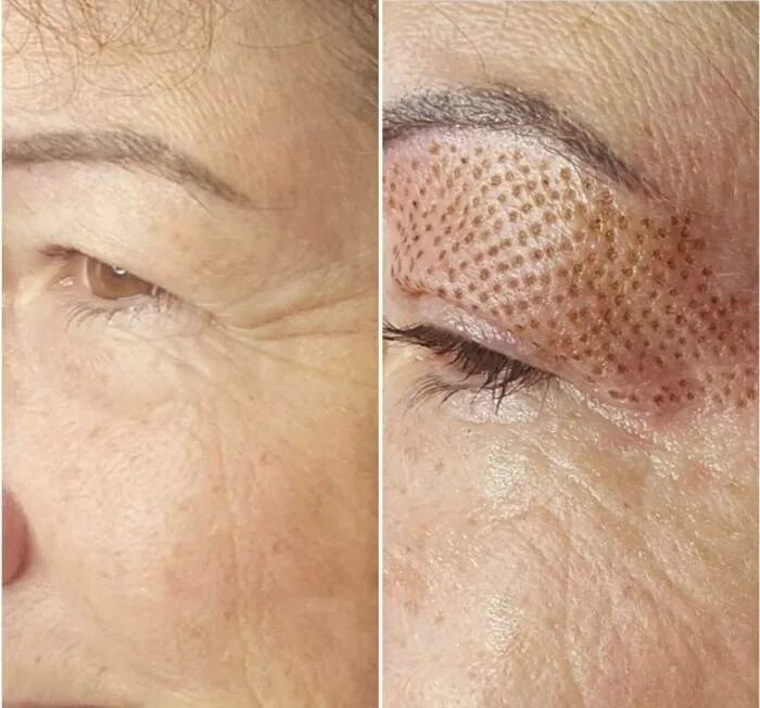 кожа век красивая. омоложение век. омоложение век. омоложение век. мелкие мимические морщины.