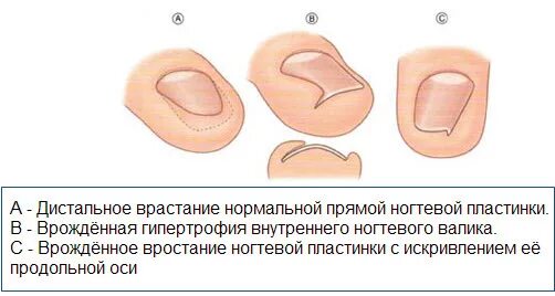 Краевая резекция пластины. Краевая резекция вросшего ногтя нагноение. стадии врастания ногтей на ногах.
