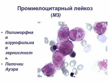 Острый промиелоцитарный лейкоз по утвержденным клиническим рекомендациям