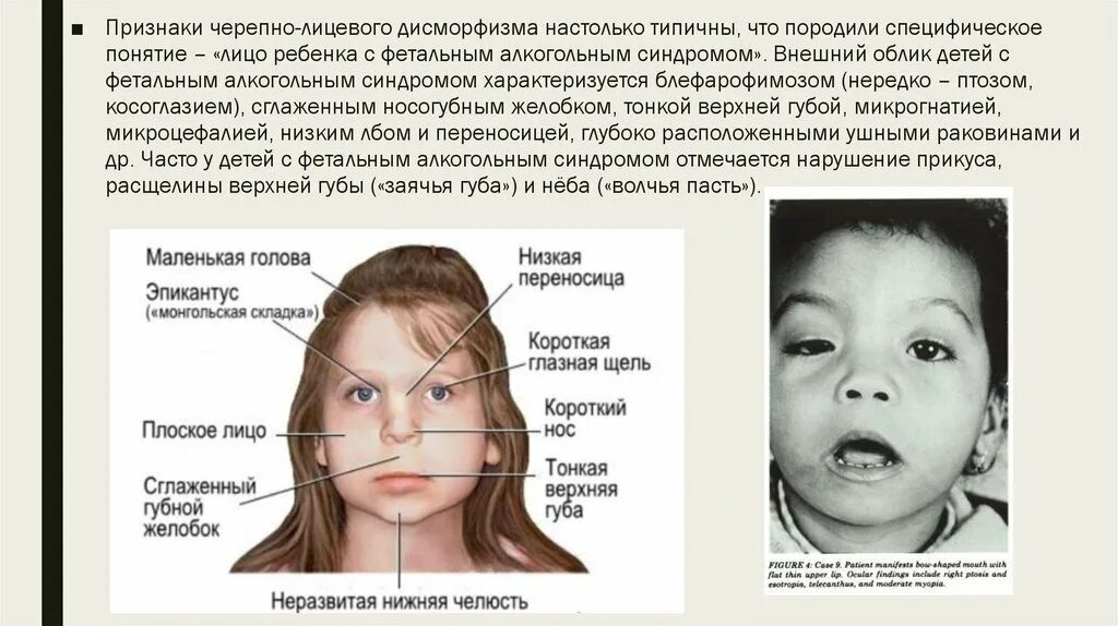 Алкогольный синдром у взрослых. ФАС алкогольный синдром у детей. Фетальный алкогольный синдром. ФАС фетальный алкогольный синдром. Фетальный алкогольный синдром лицо.