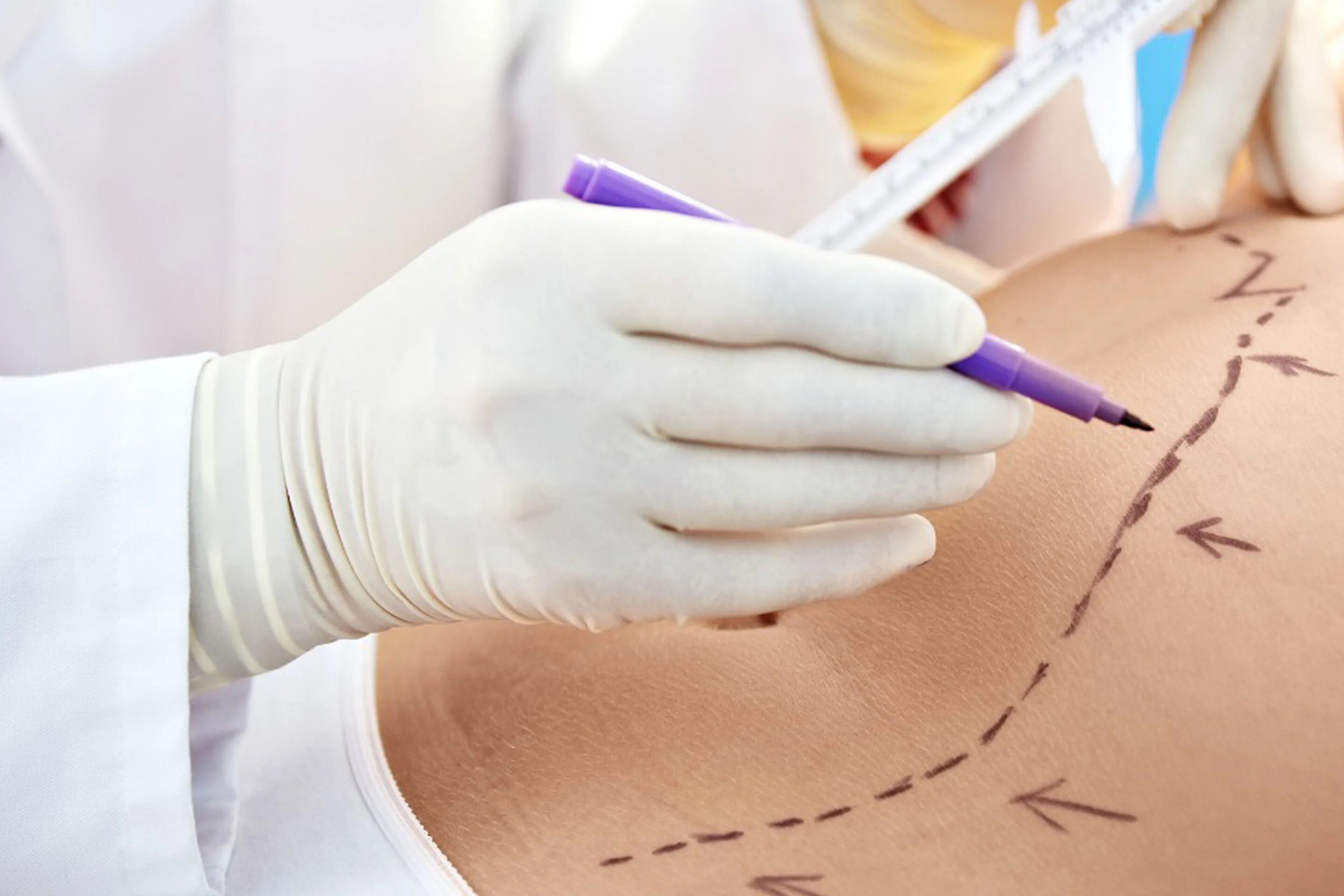 Как делают липосакцию. Хирургическая липосакция. Липосакция липоскульптура. Липосакция липоскульптурирование. Лазерный липолиз целлюлит.