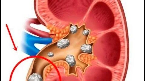 Ureteroscopy - Uci Urology 908