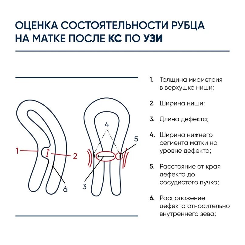 Несостоятельность рубца на матке УЗИ признаки. Оценка состоятельности рубца на матке после кесарева. УЗИ состоятельности рубца на матке. Оценка рубца на матке по УЗИ. Толщина матки после кесарева