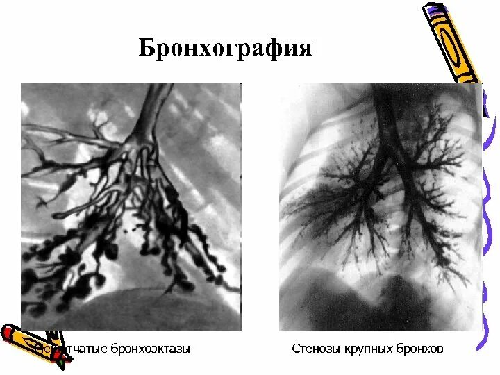 Спадение бронха