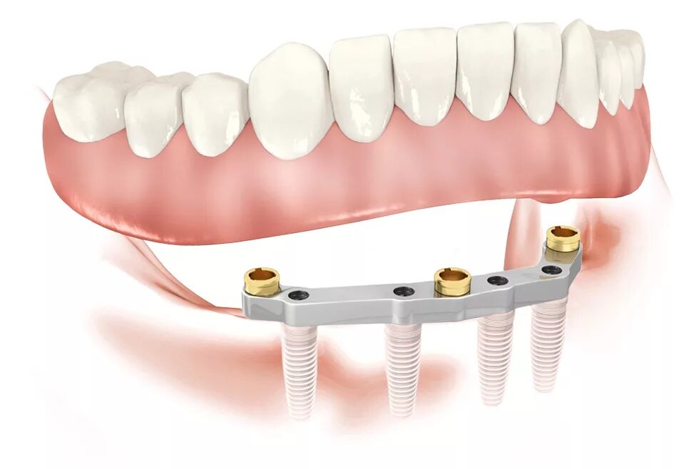 Покрывной протез на балке на 4 имплантах. Покрывной протез на 4 имплантах. Полный покрывной протез на балке на 4-х имплантах.