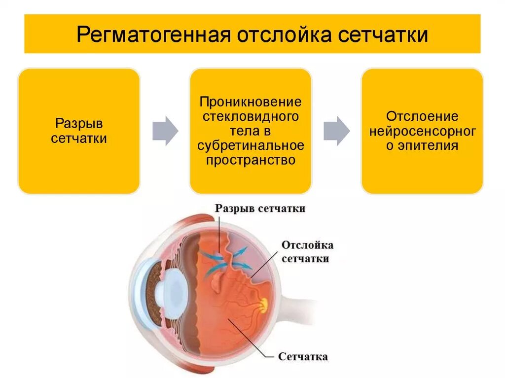 Дифференциальный диагноз отслойки сетчатки. Этиология отслойки сетчатки глаза. Диф диагноз первичной и вторичной отслойки сетчатки. Патогенез отслоения сетчатки. Диагноз сетчатки