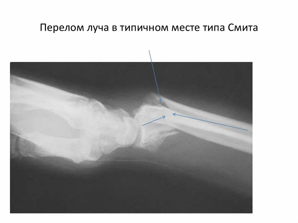 Перелом Смита лучевой кости. Перелом лучевой кости в типичном месте Смита. Перелом лучевой кости в типичном месте колеса и Смита. Перелом Смита и колеса рентген.