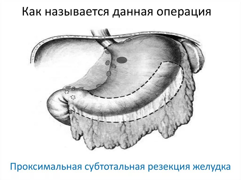 Схема субтотальной резекции желудка. Проксимальная субтотальная резекция желудка схема. Проксимальная субтотальная резекция желудка показания. Радикальная субтотальная резекция желудка. Как называлась данная операция