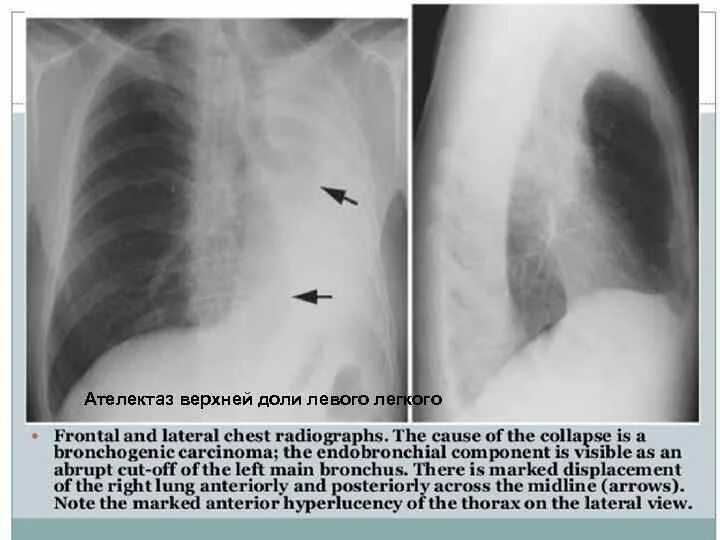 Ателектаз средней доли легкого. Ателектаз верхней доли легкого рентген. Сегментарные ателектазы легких рентген. Ателектаз сегментарный на рентгенограмме. Ателектаз левой доли легкого