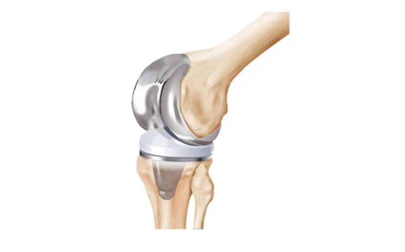 Genesis 11ps эндопротез коленного сустава. Протез Зиммер коленный сустав. Модульный эндопротез коленного сустава цито. Эндопротез локтевого сустава DEPUY.