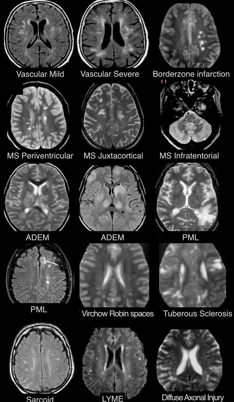 Очаги глиоза в головном мозге мрт. Рассеянный склероз на мрт головного мозга. Периваскулярные пространства Вирхова-Робина мрт головного мозга. Глиозный очаг мрт. Что означает очаговое изменение мозга