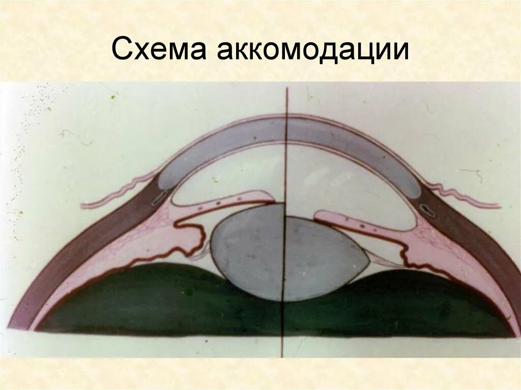 Аккомодация рисунок. Аккомодация аккомодационный аппарат. Аккомодация хрусталика. Хрусталик при спазме аккомодации. Механизм аккомодации хрусталика.