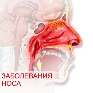 Как вылечить сопли в носу