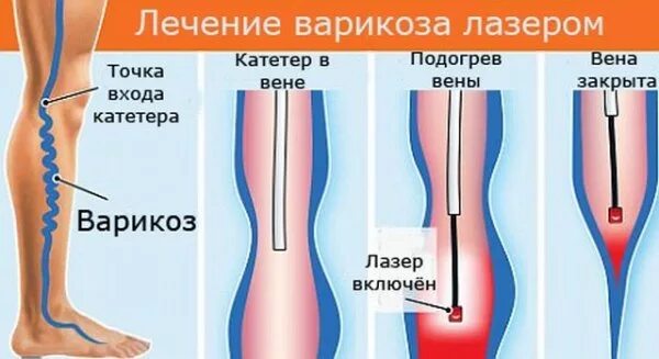 Эндовазальная лазерная коагуляция вен. Эндовенозная облитерация вен. Эндовенозная лазерная облитерация вен нижних конечностей. Лазерная облитерация (коагуляция) вен.