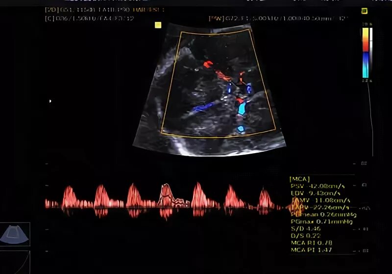 Сма плода. Средняя мозговая артерия допплер норма. Средняя мозговая артерия плода допплер норма. Допплерометрия кровотока средняя мозговая артерия нормы. Скорость кровотока в средней мозговой артерии плода.
