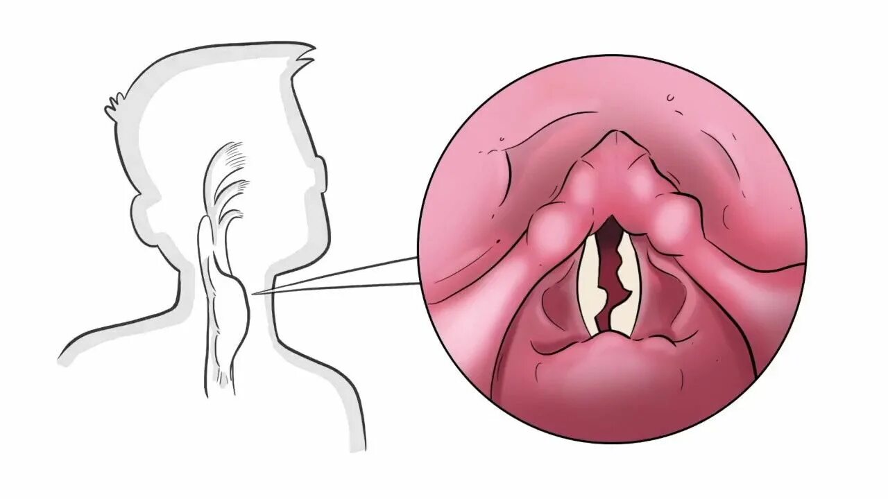 Хриплые голосовые связки. Полип голосовой складки. Афония голосовые складки. Дисфония афония это.