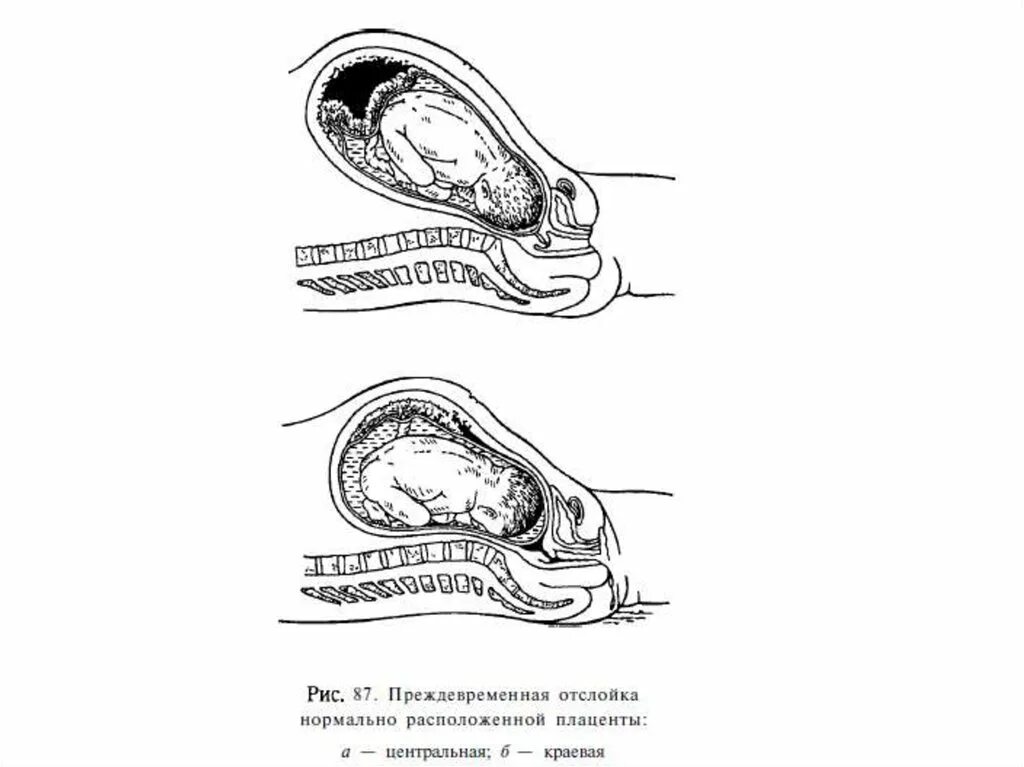 Отслоение плаценты на поздних сроках. Центральная отслойка плаценты. отслойка нормально расположенной плаценты. преждевременная отслойка плаценты классификация. отслойка плаценты в родах.